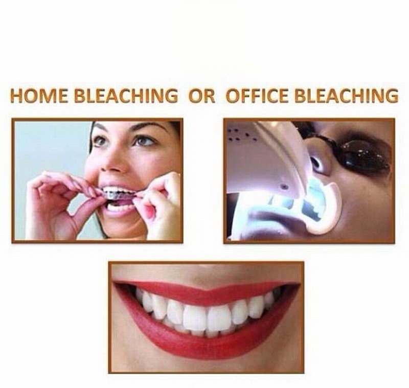 انواع روش های بلیچینگ